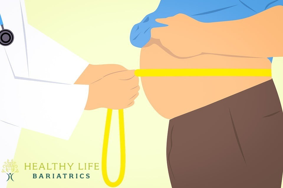 Gastric Sleeve is best Bariatric Surgery LA, CA