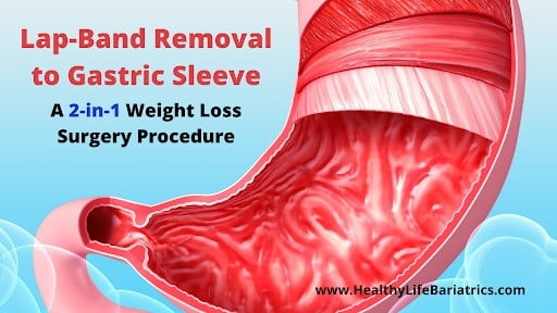 A stomach with the words lap band removal gastric sleeve.