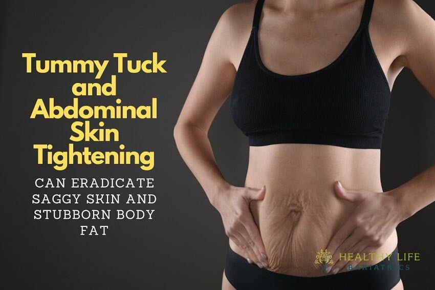 Tummy Tuck