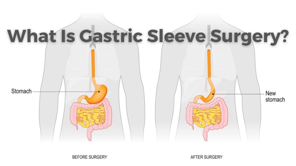 Gastric Sleeve Surgery