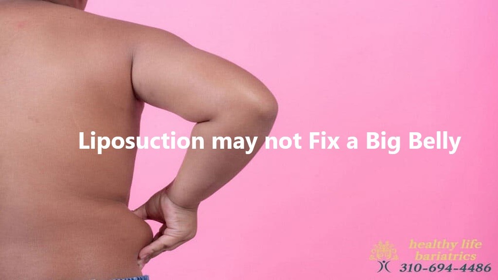 Liposuction may not always be effective in reducing a big belly.