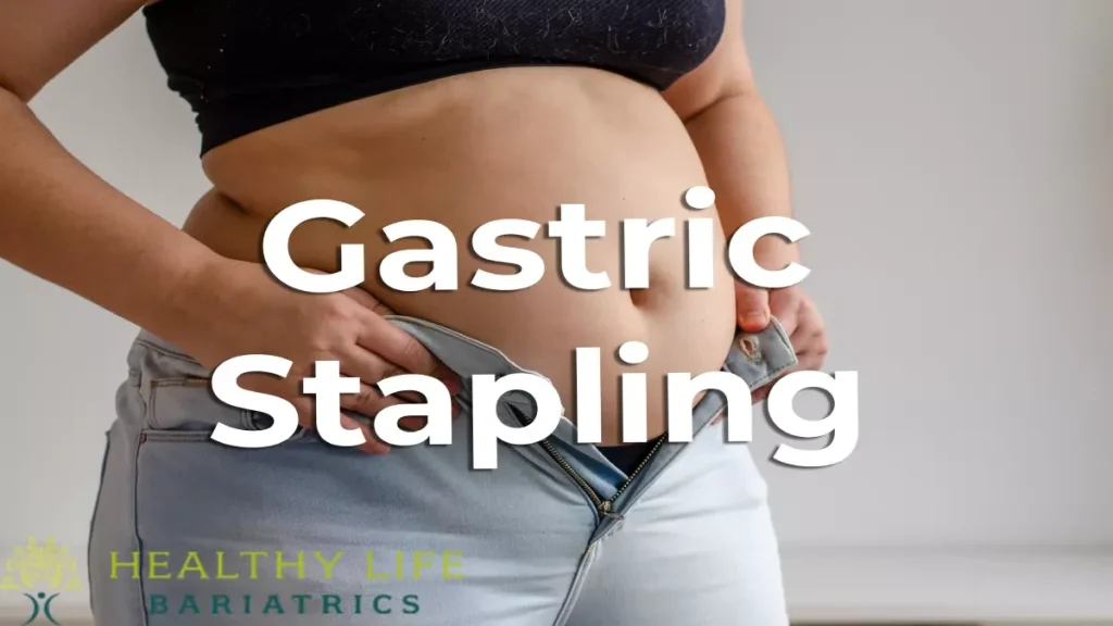 Gastric Stapling