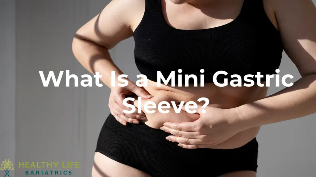 What Is a Mini Gastric Sleeve LA, CA